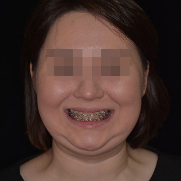 Ортодонтическая подготовка к ортогнатической операции