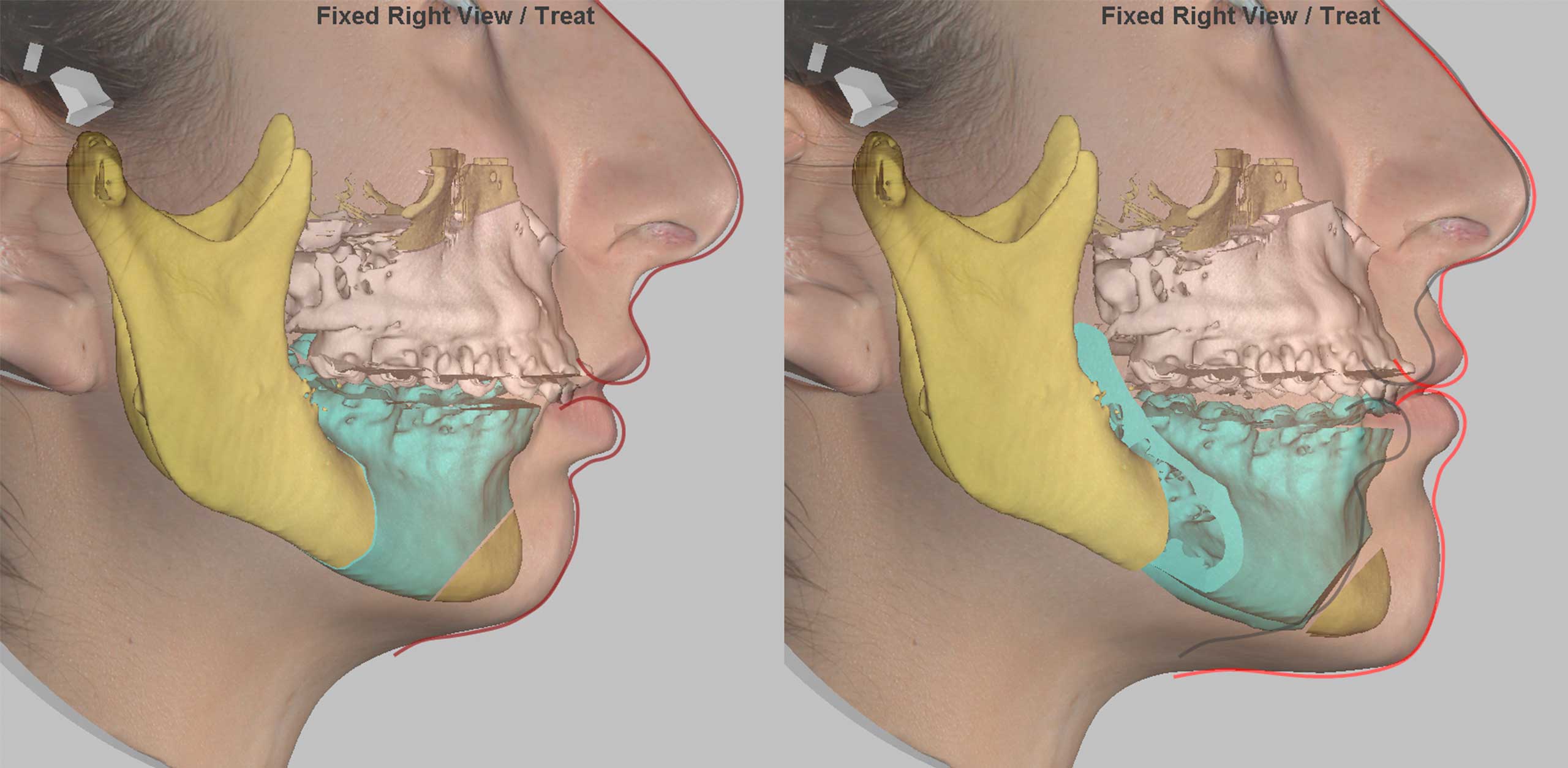 Планирование комплексного ортодонтическо-хирургического лечения — расчёт хирургического передвижения челюстей и прогнозирование изменения мягких тканей лица.