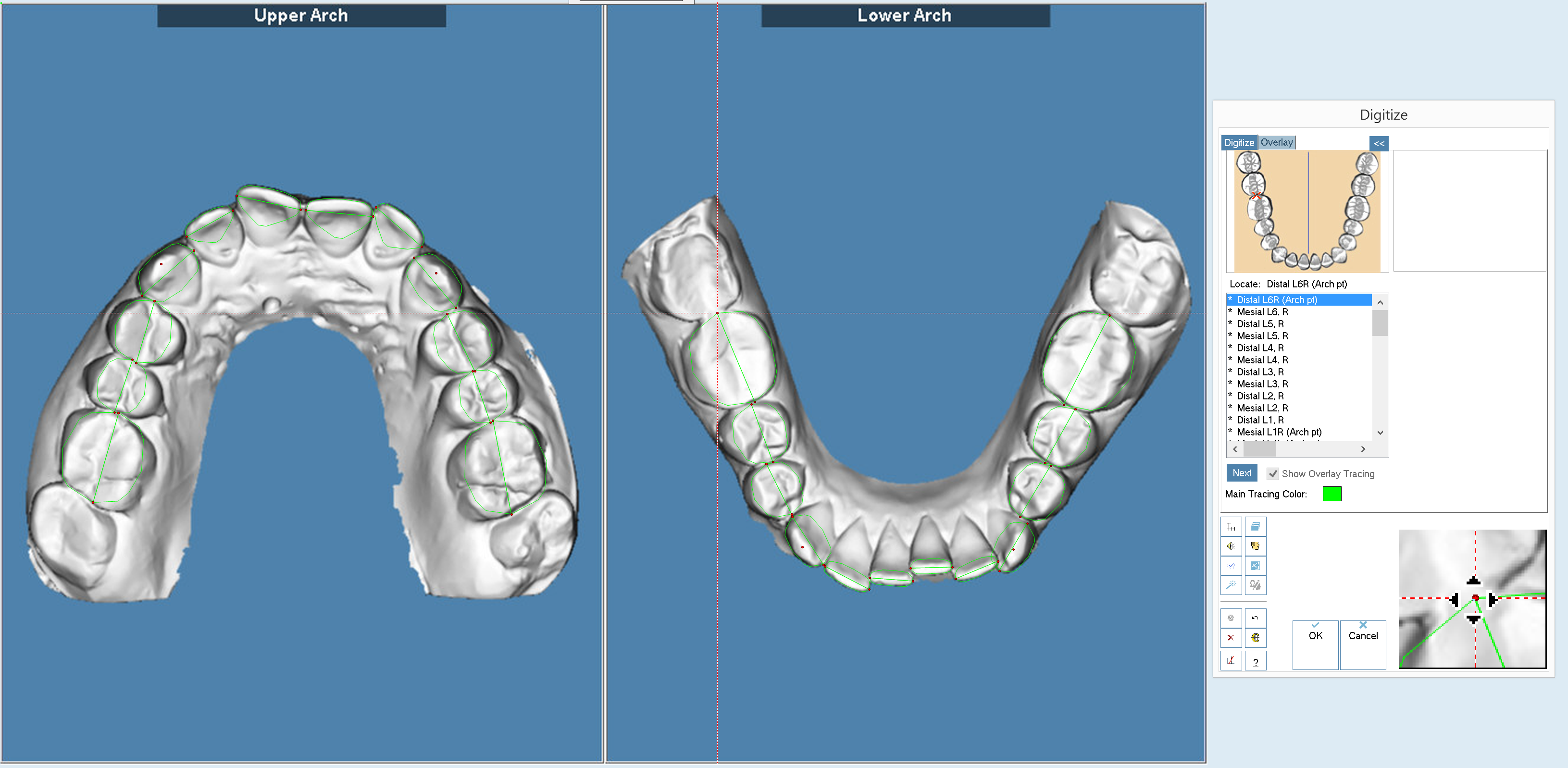 Планирование комплексного ортодонтическо-хирургического лечения — анализ и прогноз ортодонтического перемещения зубов на компьютере в специальной 3D программе.