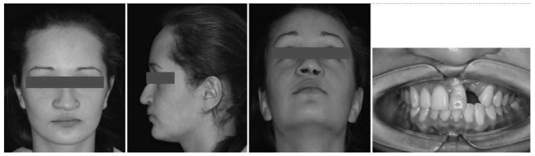 Комплексная реабилитация пациента с односторонней врожденной расщелиной губы, неба и альвеолярного отростка (клиническое наблюдение)