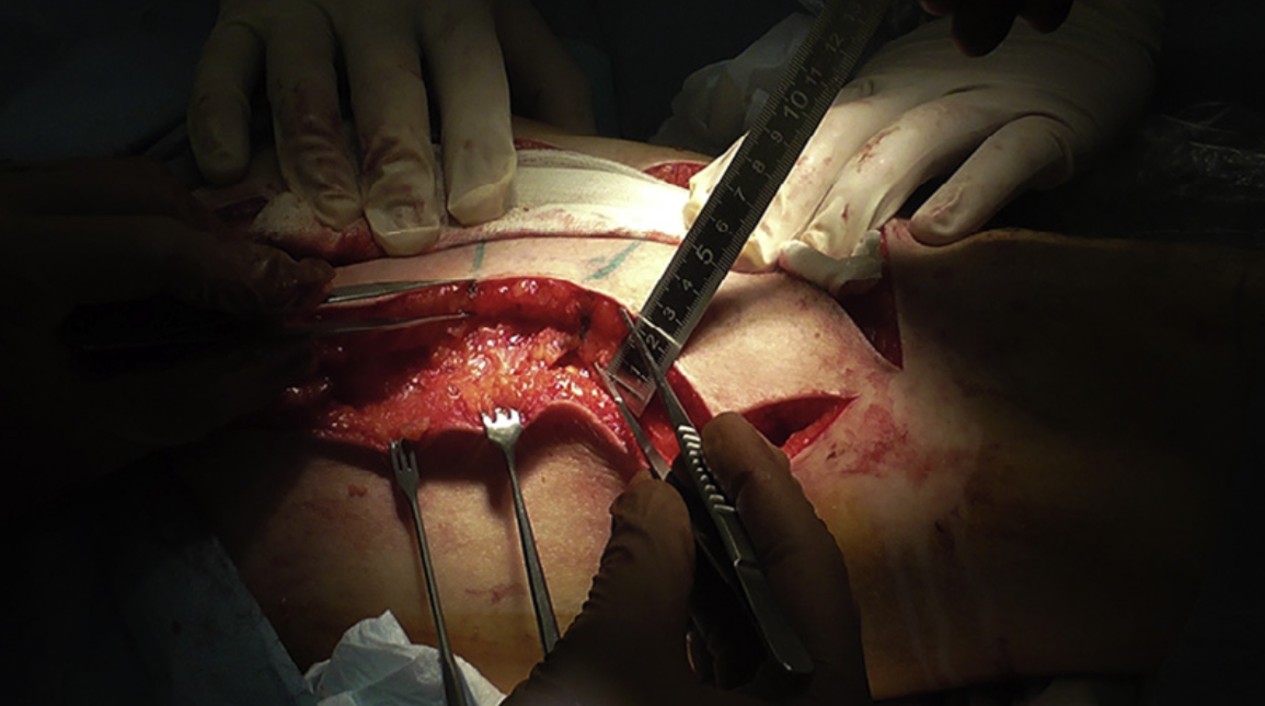 Figure9. Thirdpatient,intraoperativevaryingthicknessofALTflapharvest.Harvestofaprimary-thinnedadipocutaneousALT flap in progress. Ruler and forceps demonstrating the varying thickness in different areas of the ALT flap as per the template (see Figure 8).