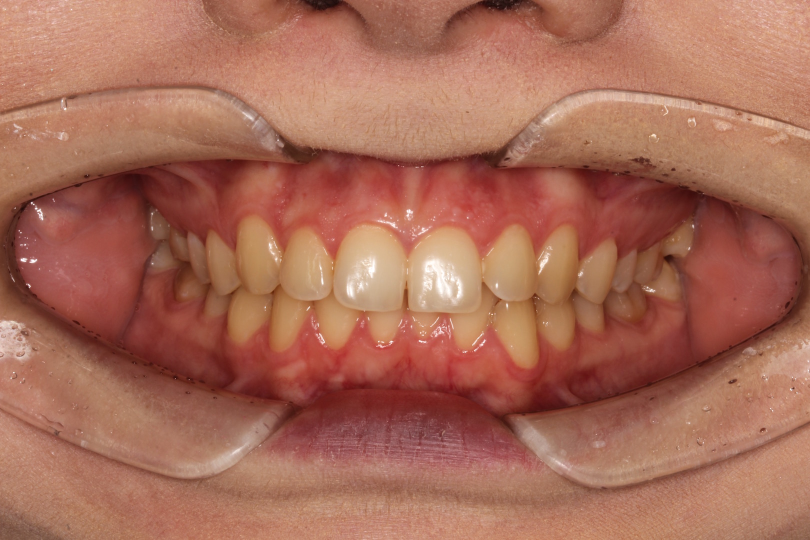 Рис. 4. Фото лица в ЕПГ, при расслабленных мимических мышцах и зубных рядов в положении привычной окклюзии