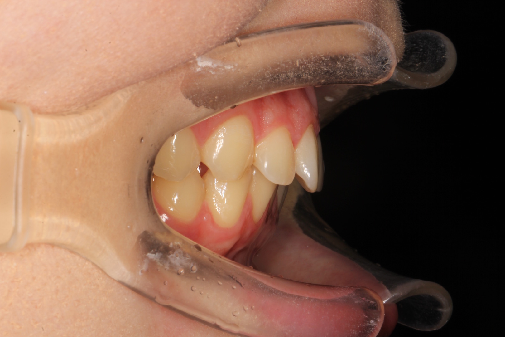 Рис. 4. Фото лица в ЕПГ, при расслабленных мимических мышцах и зубных рядов в положении привычной окклюзии