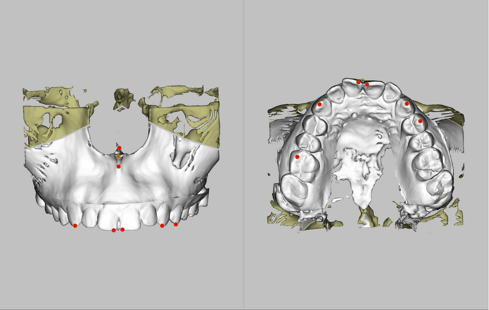 Рис. 9. Цефалометрические ориентиры в виде точек спроецированы на костные структуры лицевого скелета и зубы