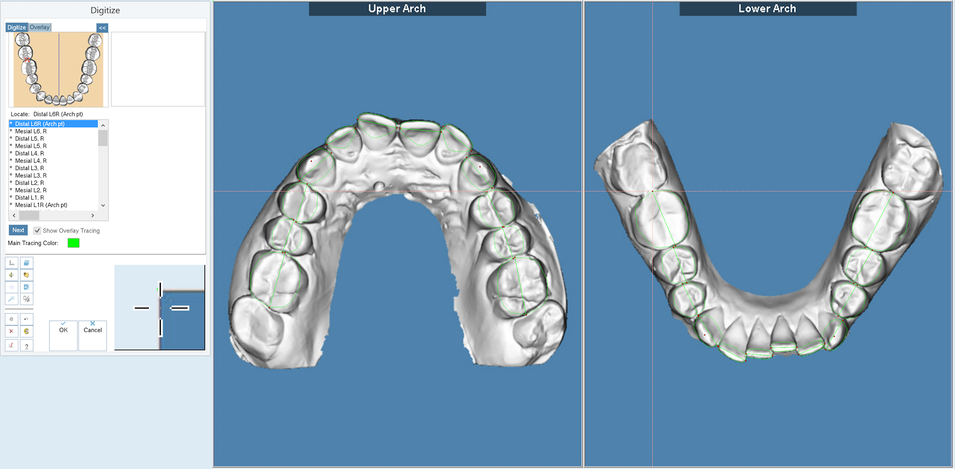 Рис. 1. Оценка моделей зубных рядов на основании анализа Bolton